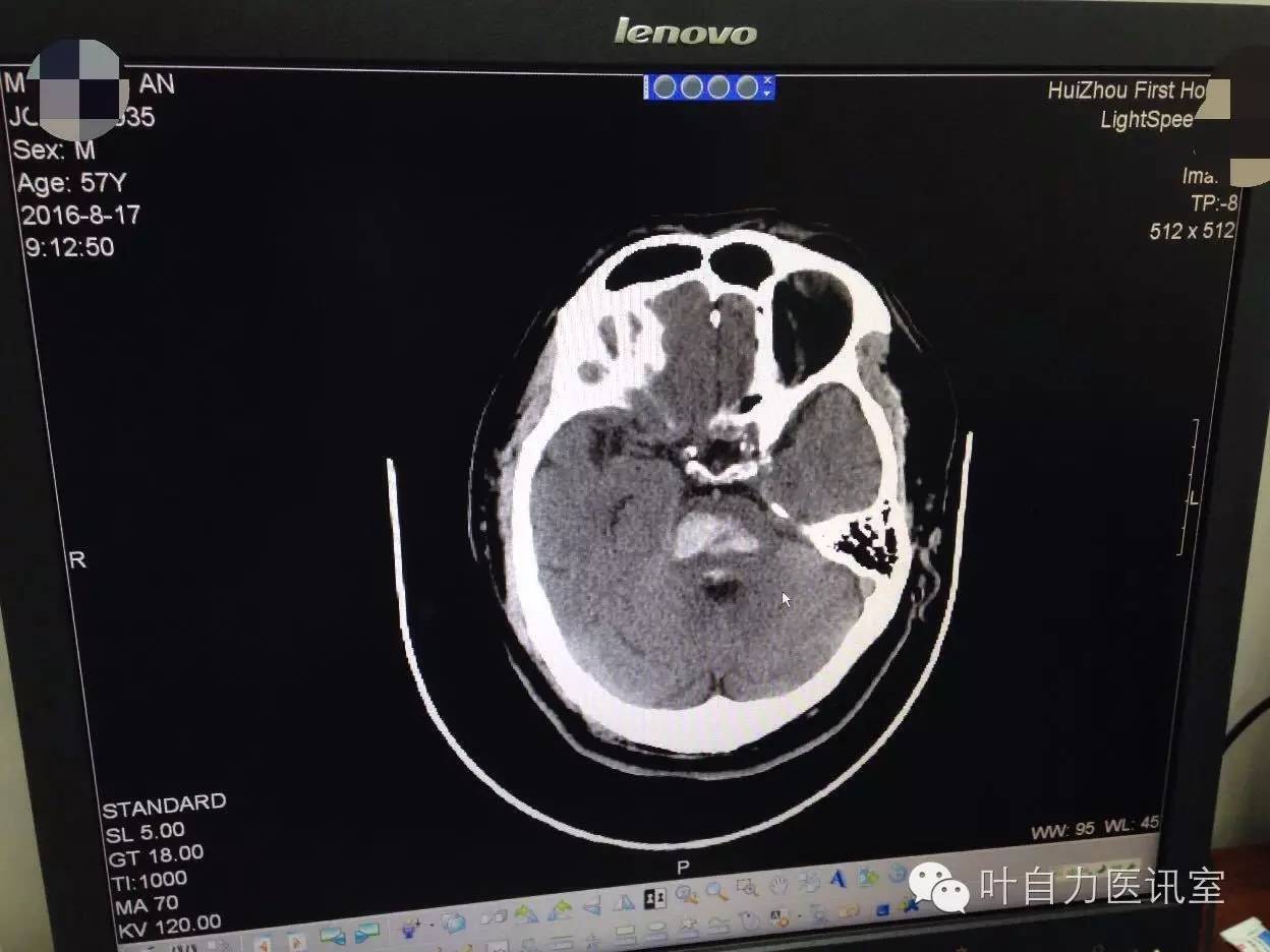 (二)头颅CT和MRI扫描-医学教育-医学