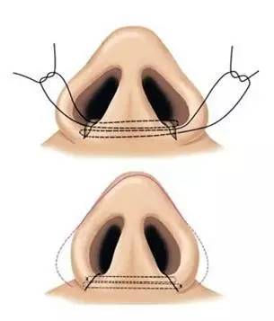 一般来说,鼻头和鼻翼缩小手术比单纯隆鼻手术难度更大.