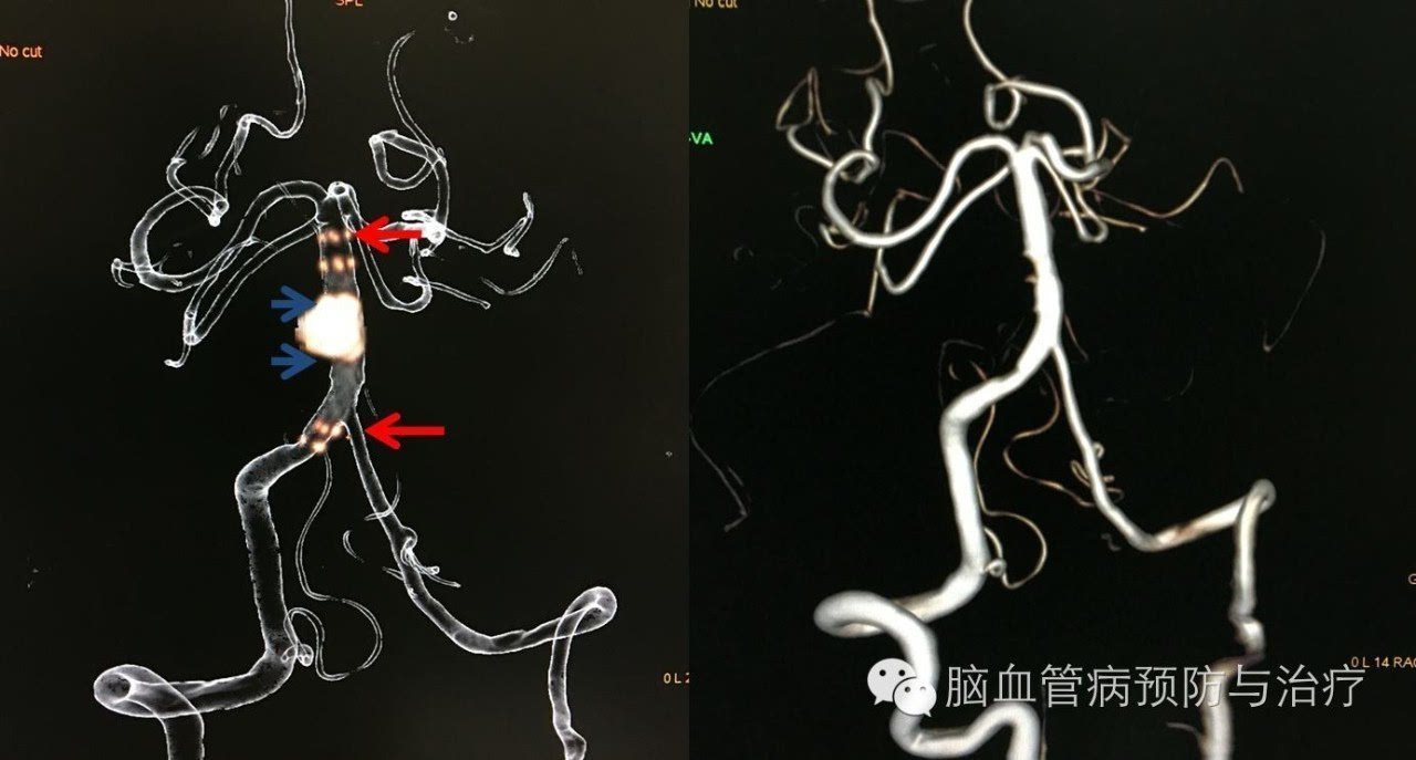 术后dsa:红箭头示enterprise血管内支架,蓝箭头示动脉瘤内弹簧圈影