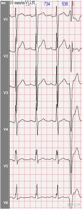 每天学看一份心电图预激综合征