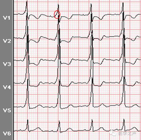 每天学看一份心电图预激综合征