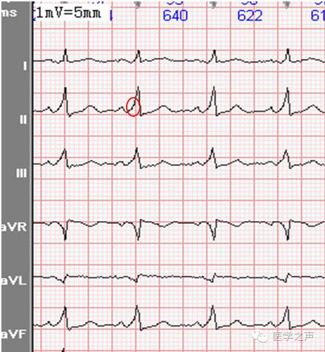 每天学看一份心电图预激综合征