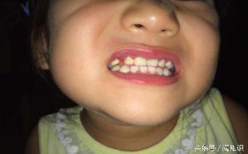 宝宝张牙齿的各种问题