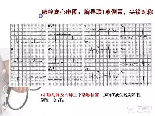 精彩幻灯:肺栓塞的心电图诊断