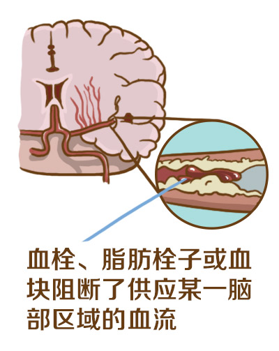 漫画认识脑血管病