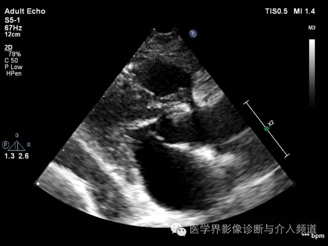 健康 正文  主动脉夹层(a型) 主动脉瓣二叶畸形 主动脉窦部及升主动脉