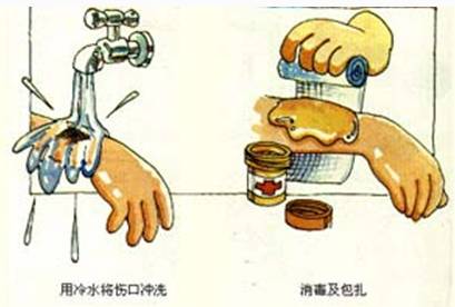 其它 正文  处理烧伤的原则 1,立即用冷水冲洗,或将烧伤的部位全部泡