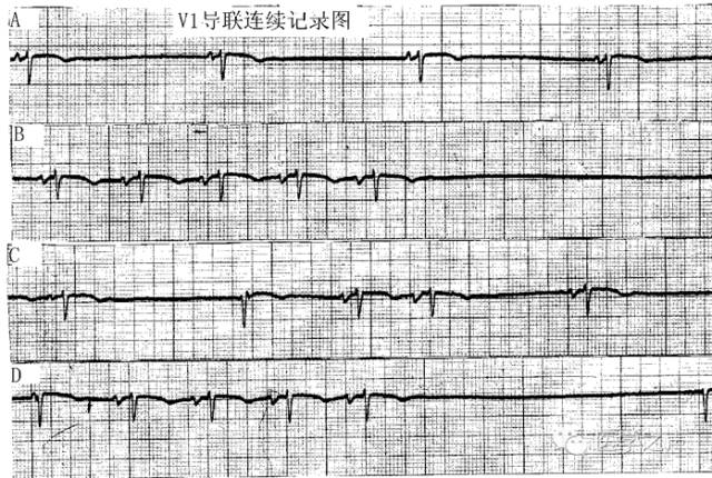 每天学看一份心电图第24期病态窦房结综合征