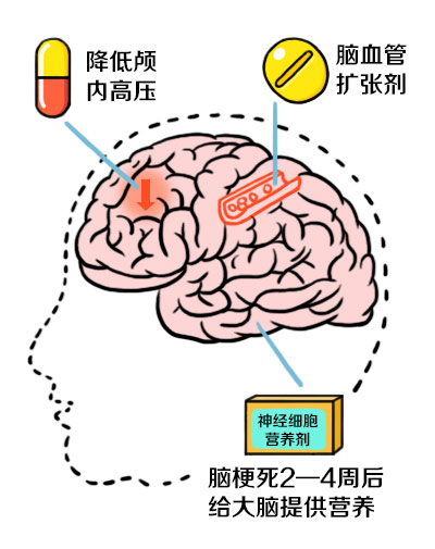 急性脑梗死去了医院，医生们都怎么处理的?-搜狐