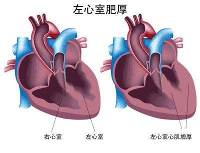 老年收缩期高血压合并左心室肥厚的危险因素分析