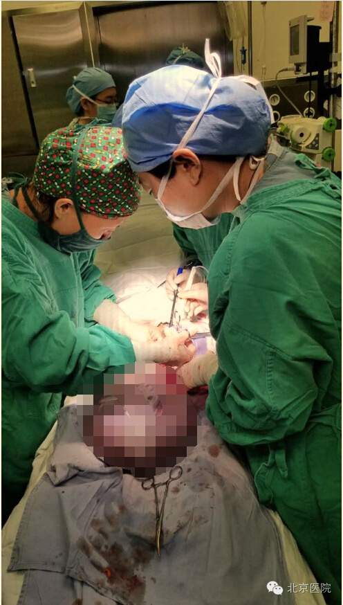 北京医院妇产科成功实施巨大卵巢囊肿切除手术