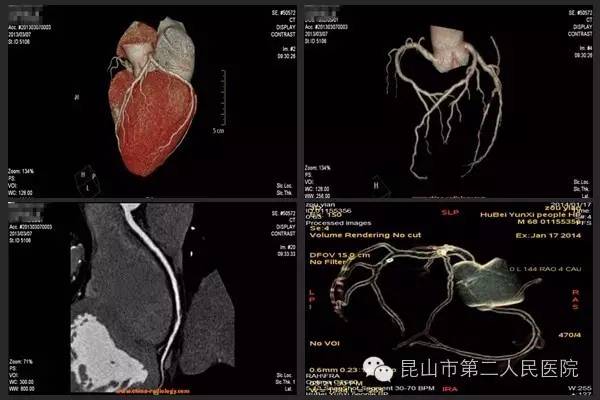 【健康贴士】心脏冠脉知多少