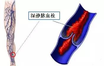 如果病情长期没有得到有效的控制 静脉血液会在下肢深静脉血管内
