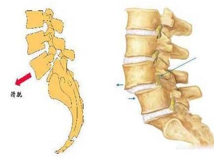 预防腰椎滑脱其实没有那么难