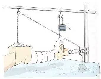 10分钟了解骨科牵引术