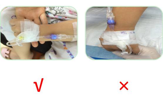 外周静脉留置针日常维护技巧