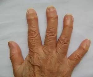 【健康】方手指,警惕骨关节炎