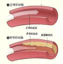 颈动脉增厚怎么办