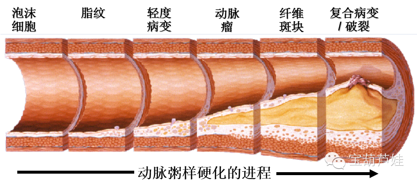 【药师在您身边】血脂与动脉粥样硬化