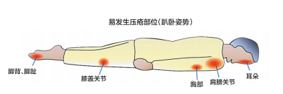 这家医院做到了体外循环心脏手术压疮 “零发生”!听其手术室“掌门人”郑丽萍讲讲都用了哪些“法宝”?