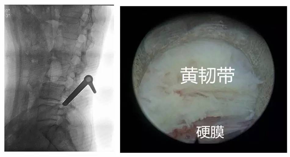 先进行硬膜囊腹侧的减压,再进行硬膜囊背侧的减压