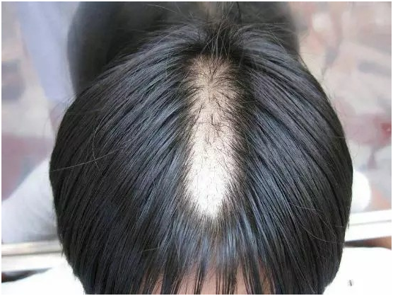 女孩的母亲说,在两个月前,发现孩子莫名其妙的掉了很多头发,当时并没