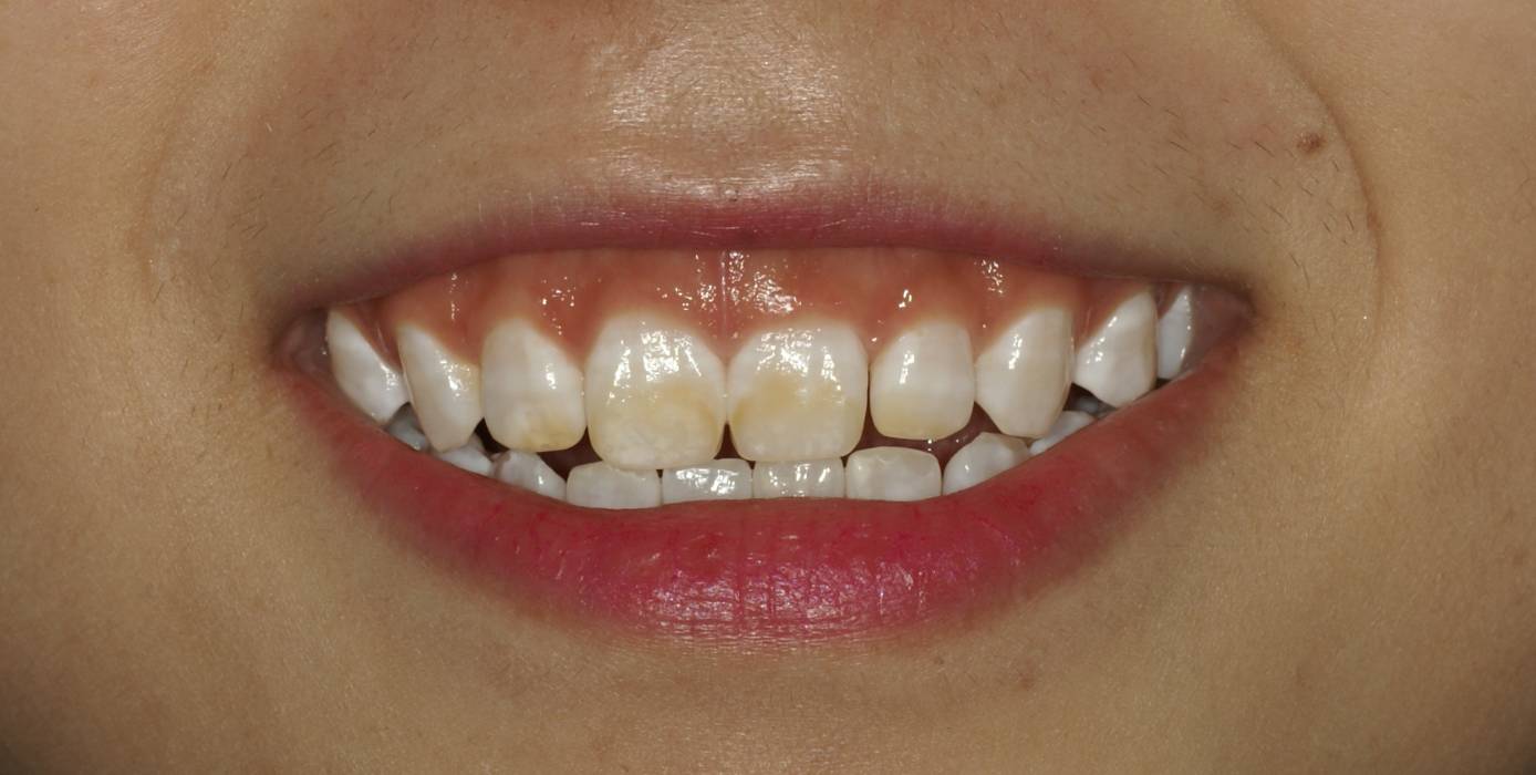 氟斑牙的治疗一例