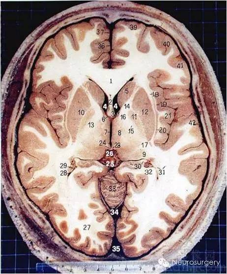 经典颅脑断层解剖图水平位