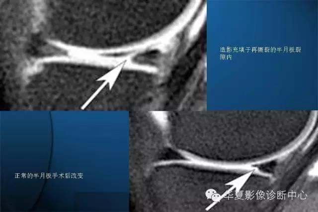 半月板病变的mr诊断