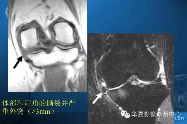 半月板病变的mr诊断