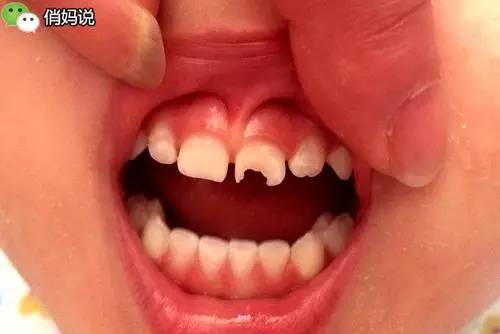 q01:反正要掉的乳牙,长龋齿后等换牙就行了吗?