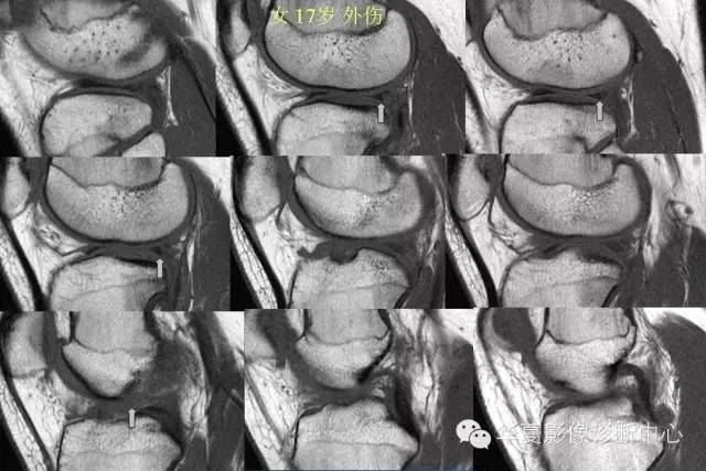 半月板病变的mr诊断