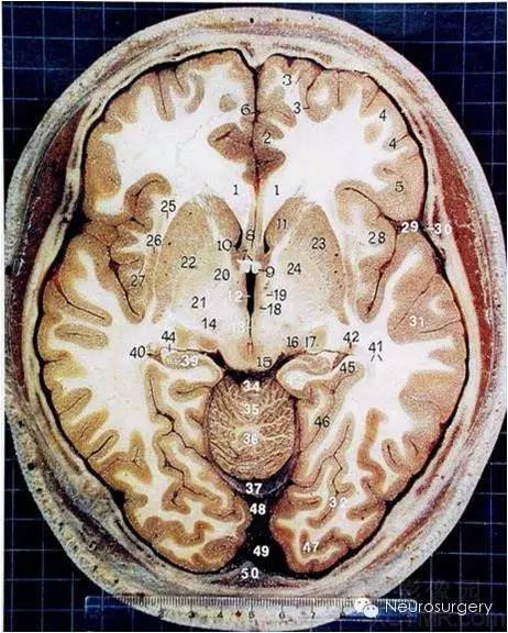 经典颅脑断层解剖图水平位