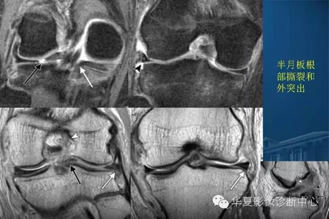 半月板病变的mr诊断