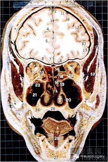 经典颅脑断层解剖图冠状位