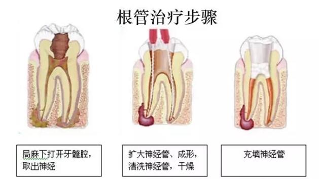 牙齿上不痛不痒的小黑点危害竟然这么大!