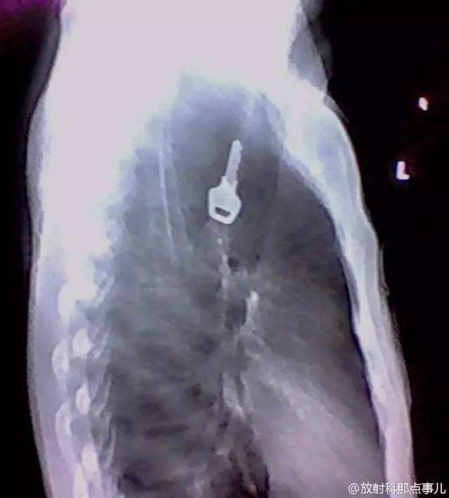 X光下的食管异物,触目惊心!