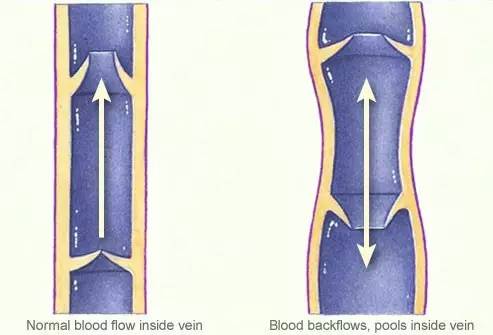 下肢静脉瓣膜功能不全,浅静脉曲张.腿部