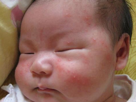 Image result for 寶寶濕疹
