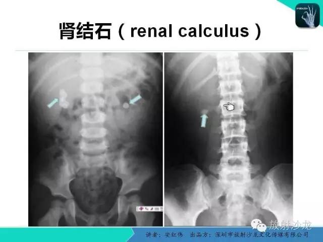 腹部急诊影像学表现大全