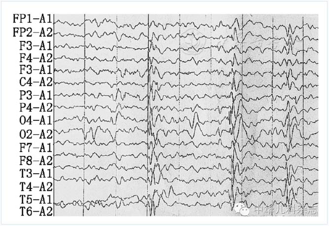 神经元蜡样质脂褐素沉积症患儿脑电图示广泛性多灶性棘波,棘慢波