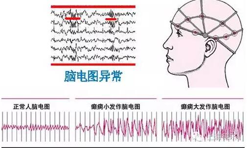 脑电图检查——癫痫诊断必备"助手",你选对了吗