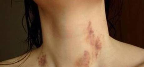 2011年,新西兰一名女子就因为脖子上被恋人留下吻痕,导致身体部分