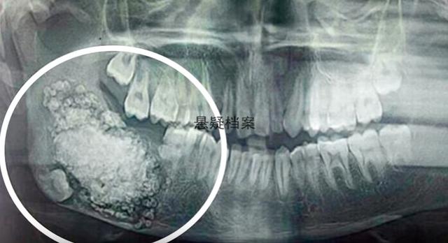 牙齿增生成祸,医生从其口中取出200多颗牙齿