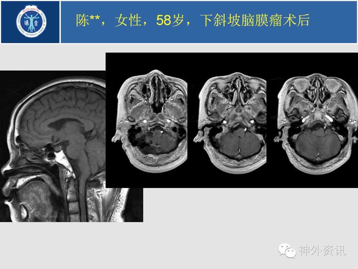 【正海-妙术视界】| 吴哲褒教授:下斜坡枕骨大孔脑膜瘤