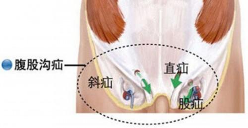 人体腹股沟疝的分型诊疗