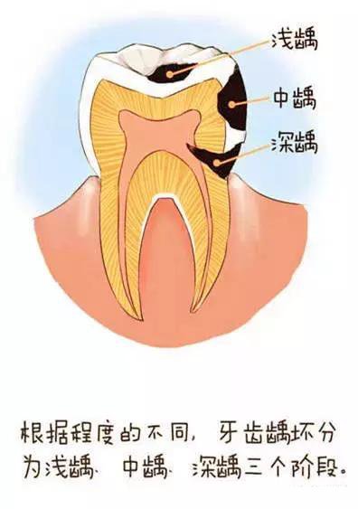 蛀牙就是牙里长虫子?