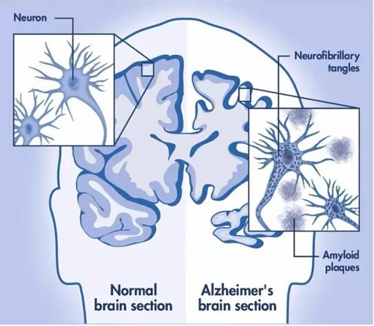 非编码rna在神经退行性疾病中的分子机制研究