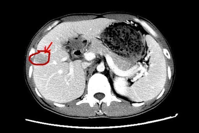 59岁女性上腹胀痛,以为是胃炎,CT却报告肝癌破