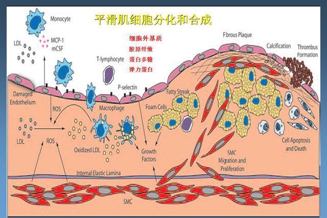 动脉粥样硬化的形成的机理